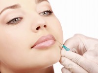 Più volume alle labbra con i filler